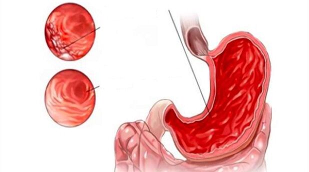 damage to the stomach lining when drinking alcohol