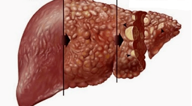 harmful effects of alcohol on human liver