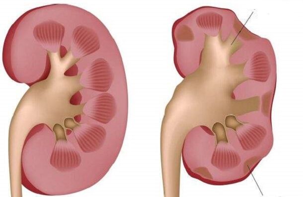 healthy kidneys and get sick from drinking